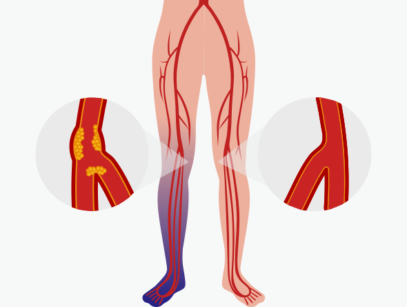 აორტისა და პერიფერიული სისხლძარღვების დაავადებები – დიაგნოსტიკა და მკურნალობა „ნიუ ჰოსპიტალსში“
